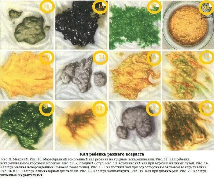 Какой бывает понос. Норма детского стула у новорожденного. Нормальный калл у новорожденного. Нормальный кал у новорожденных на смешанном вскармливании 1 месяц.