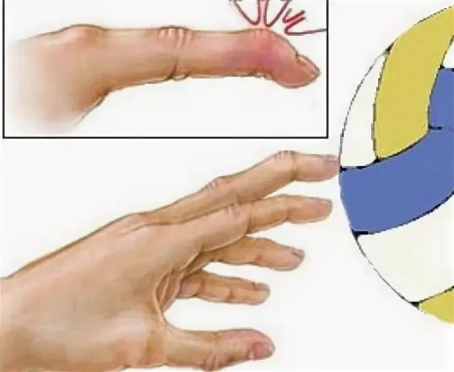 Кольцевидные связки большого пальца кисти. Стенозирующий лигаментит нотта. Сухожилия указательного пальца. Мышцы кисти вид спереди. Разрыв связок на безымянном пальце.