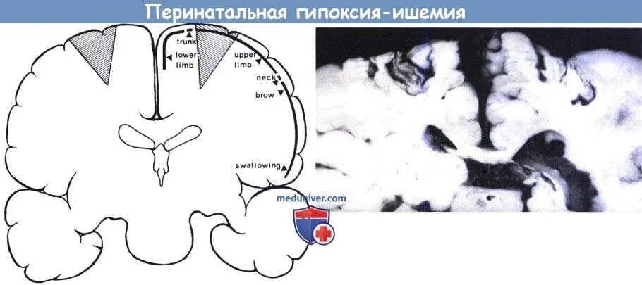 Церебральная ишемия у новорожденного 2. Гипоксическая ишемическая энцефалопатия новорожденного. Гипоксическая травма головного мозга. Ишемия 1-2 степени у новорожденных. Перинатальная гипоксия ишемия.