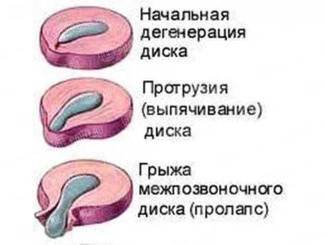 Протрузия межпозвонковых дисков. Что такое протрузии межпозвоночных дисков. Протрузия дисков позвоночника что это такое. Выпячивание диска позвоночника.