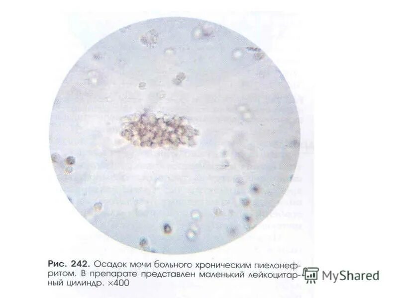 Слизь в моче у подростка