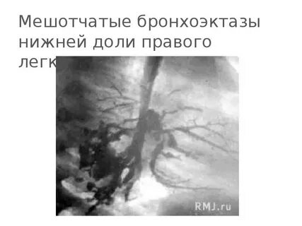 Боли в нижних долях легких