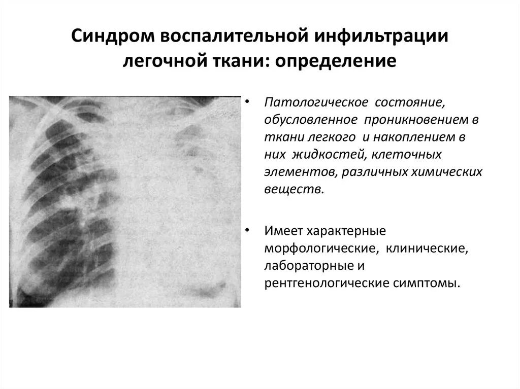 Стадия инфильтрации легких. Синдром инфильтрации легочной ткани рентген. синдром воспалительной инфильтрации легких (уплотнение). лучевая диагностика синдрома инфильтрации легочной ткани. синдром воспалительной инфильтрации легочной ткани.
