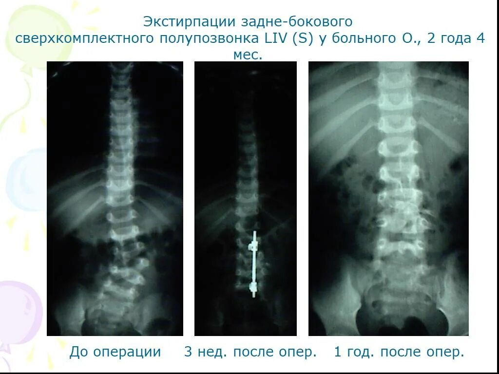 Аномалии развития позвоночника. Боковой клиновидный полупозвонок. Врожденный дефект позвоночника. Аномалии развития позвоночника у детей. Операции при аномалиях развития позвоночника.