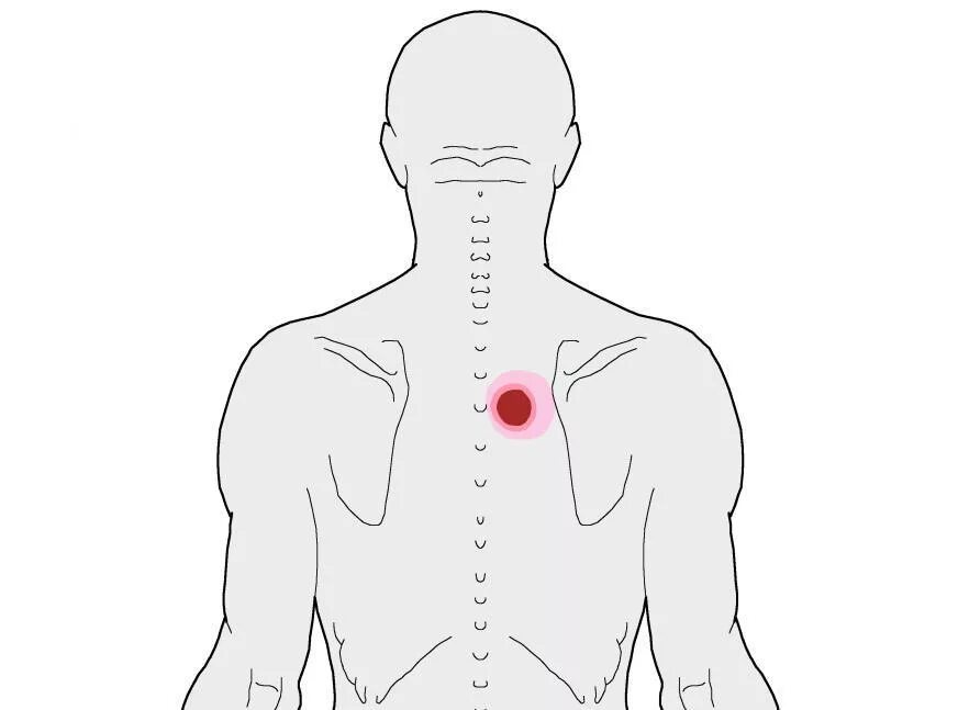 Ноющая боль в верхней части. Болит между лопатками. Боль в спине. Спина болит между лопатками. Точка между лопатками.