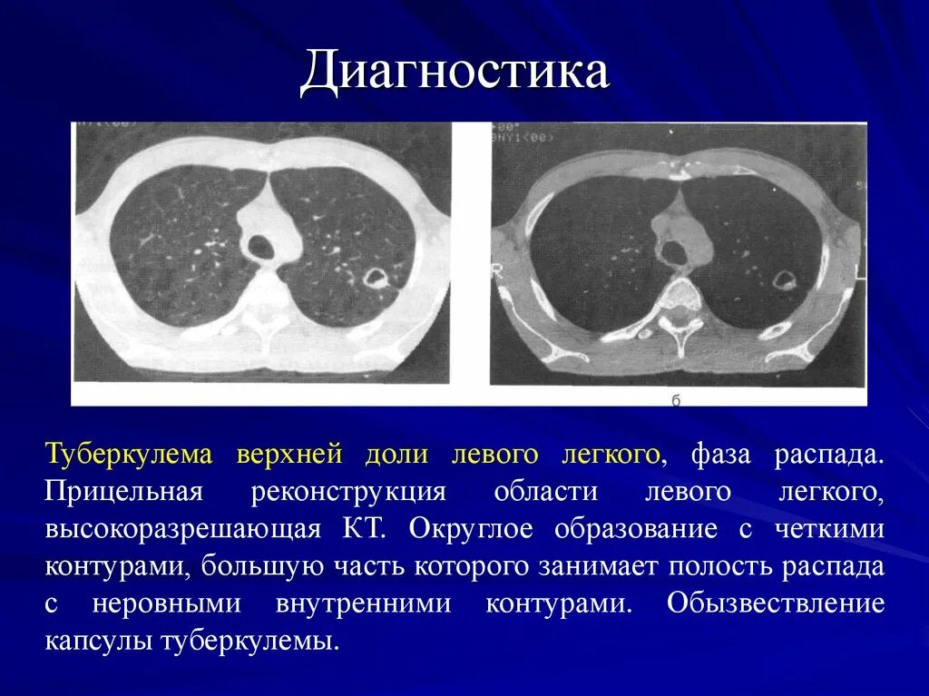 Образование полостей в легких