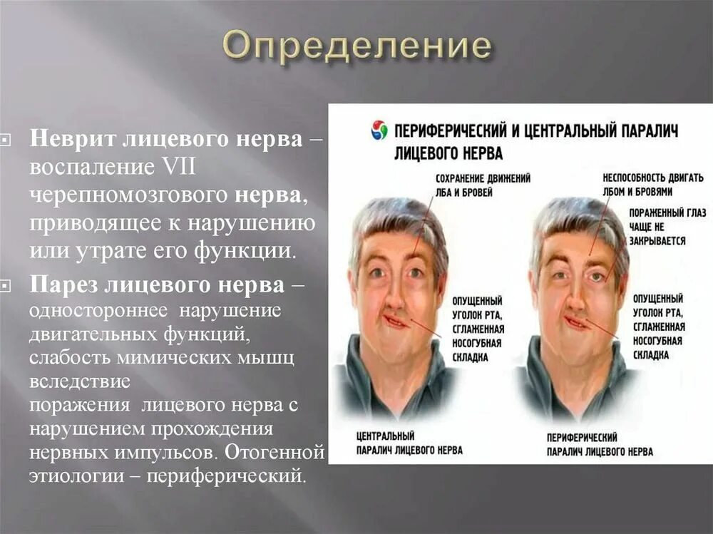 Лицевой информация. Неврит лицевого нерва с парезом. симптомы периферического пареза мышц лица. периферический паралич лицевой мускулатуры. периферический парез лицевого нерва.
