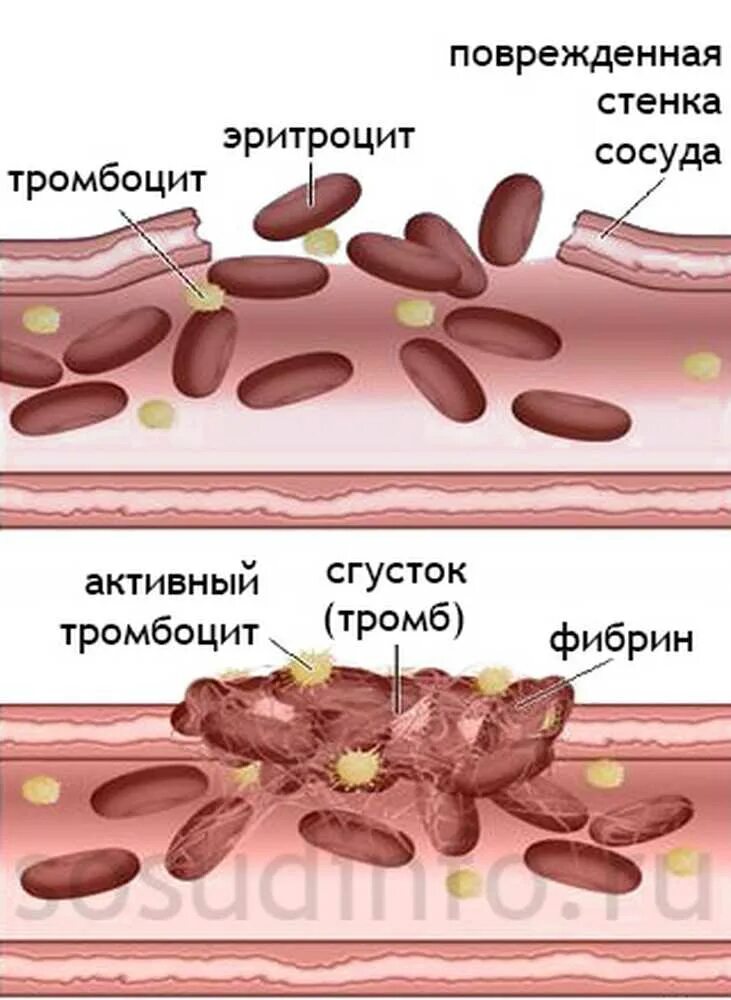 Тромбоциты образование тромба. Схема образования тромба. Образование тромба рисунок. Механизм тромбоза