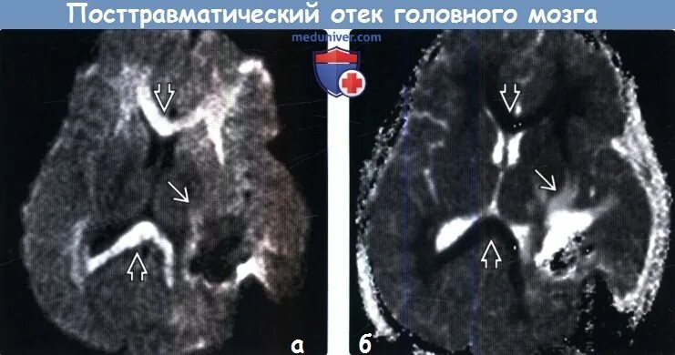 Травматический отек мозга. Травматический отек головного мозга. Перивентрикулярный отек кт. Перивентрикулярный отек головного мозга на кт.