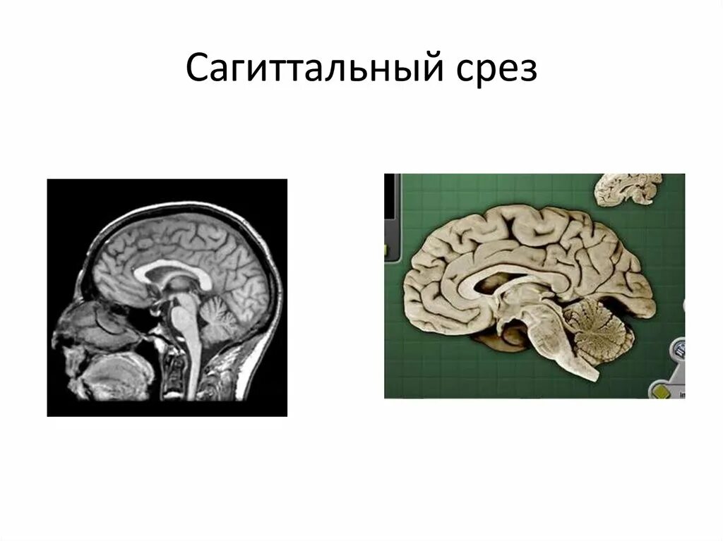Исторические срезы. Сагиттальный срез. промежуточный мозг сагиттальный срез. срезы сагиттальный фронтальный. сагиттальный срез и фронтальный срез.