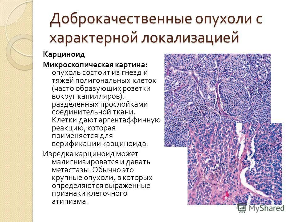 виды рака из покровного эпителия. микроскопический коллагенозный колит. новообразования почки патанатомия.
