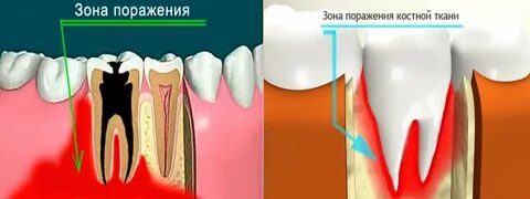 Удаление костной ткани зуба