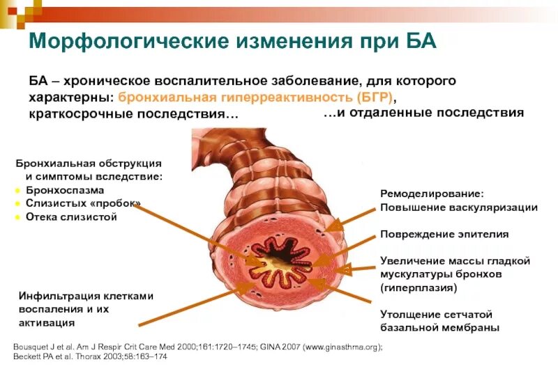 Спазм бронхиол. Бронхоспазм при бронхиальной астме. характерные клинические признаки бронхоспазма. парадоксальный бронхоспазм что это такое симптомы.