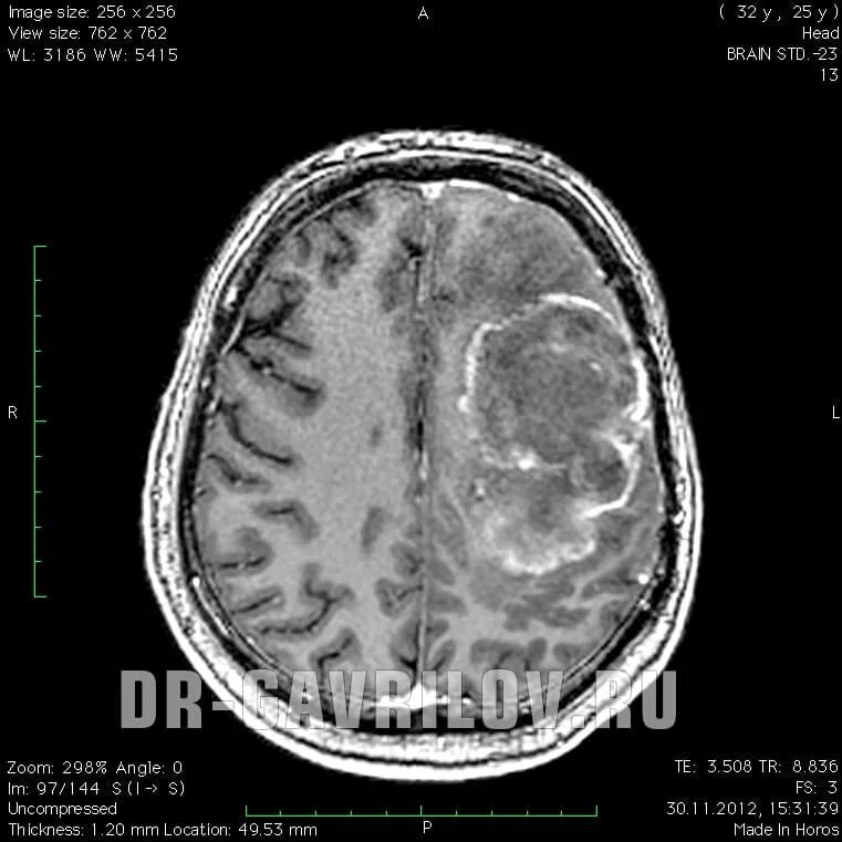 Мультиформная глиобластома. Мультифокальная глиобластома головного. Глиобластома 4 степени. Опухоль головного мозга глиобластома 4. Симптомы глиобластомы головного