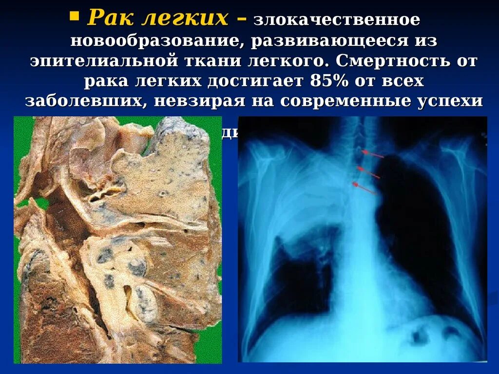 Раковая опухоль в легких. Злокачественные новообразования легких. Злокачественное новообразование легкого. Диффузный рак легких