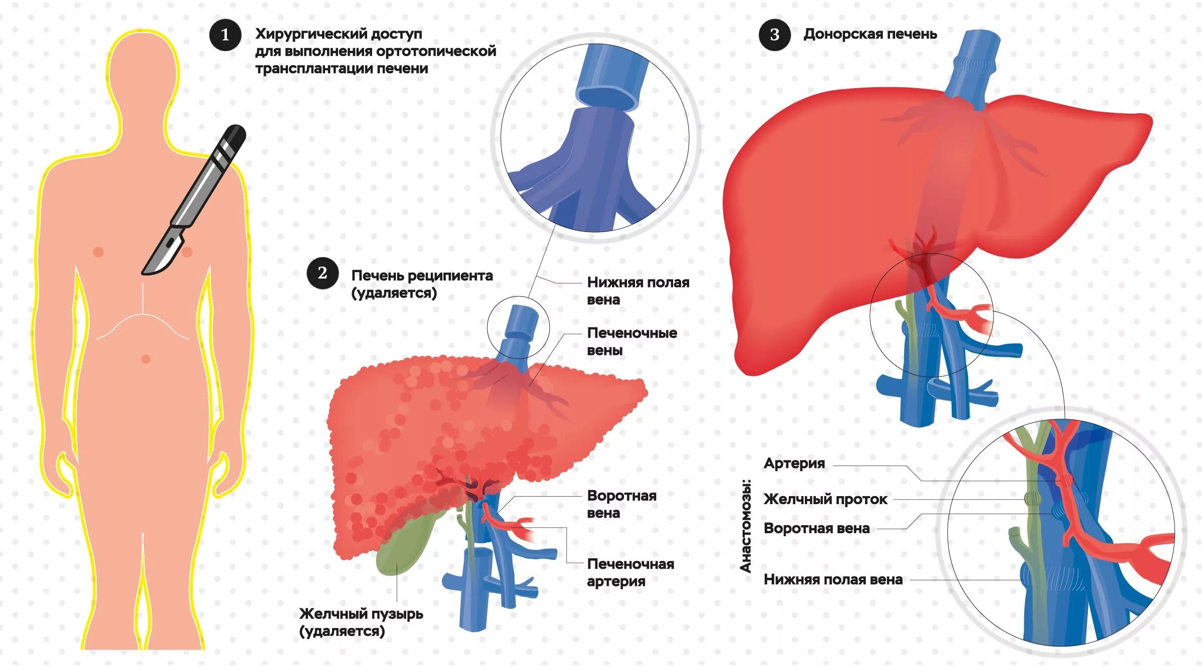 Можно ли пересадить печень. Техника ортотопической трансплантации печени. Трансплантация печени этапы. Трансплантация печени операция. Трансплантация печени схема.