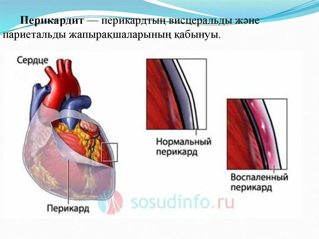 Фибринозный перикардит исход. Острый перикардит симптомы. Аутоиммунный перикардит. Перикард сердца заболевания. Перикардит развитие.