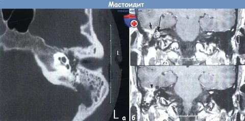 Утолщение слизистой ячеек сосцевидного отростка