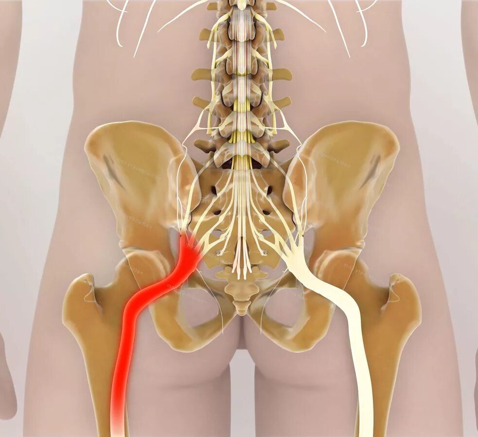 Как лечить защемление в пояснице. Пояснично-крестцовый отдел позвоночника защемление нерва. Седалищный нерв. Поясничный отдел и седалищный нерв. Защемление седалищного нерва.