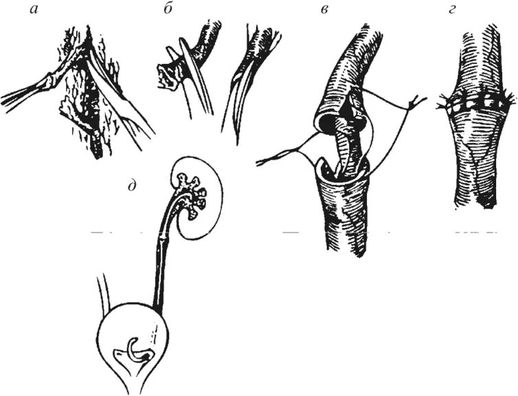 Травма мочеточника. Пластика мочеточников операции. Перфорация мочеточника стентом. Аутотрансплантация мочеточника. Шов мочеточника схема.