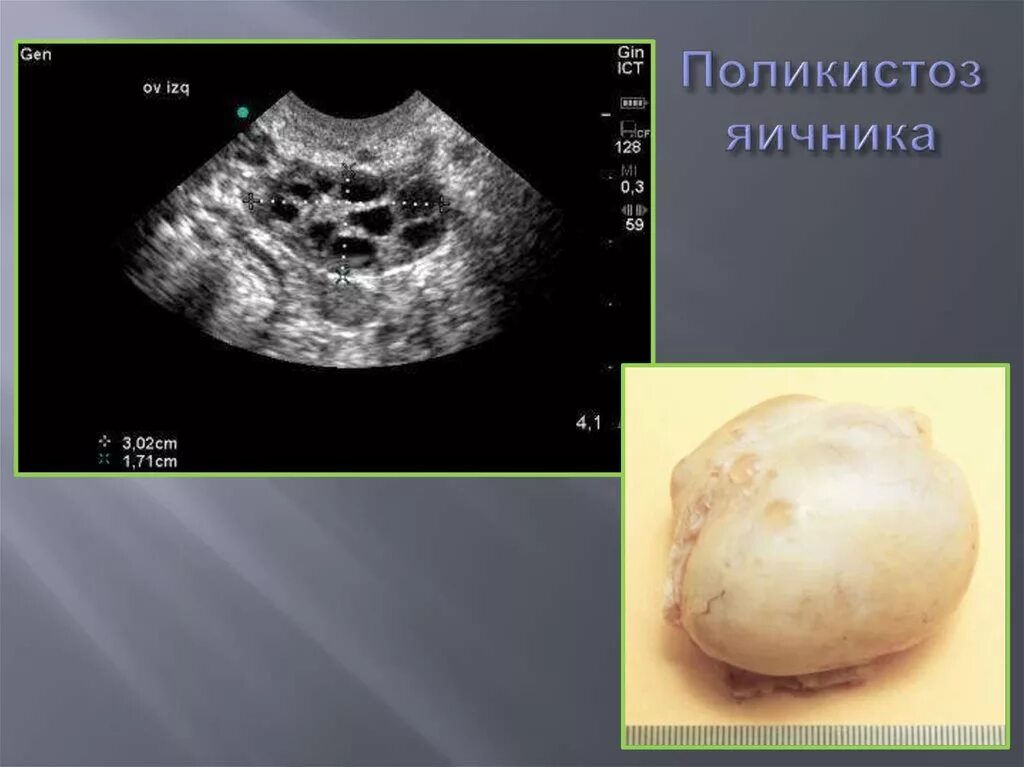 При поликистозе можно забеременеть. Снимок УЗИ поликистоз яичников. Мультикистозные яичники на УЗИ. Поликистоз яичников снимки УЗИ. Ультразвуковые критерии поликистозных яичников.