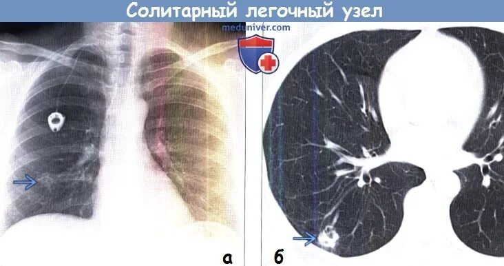 Солидный узел в легких. Солитарный легочный узел. Образование в легком кт. Солитарный узел в легком что это.