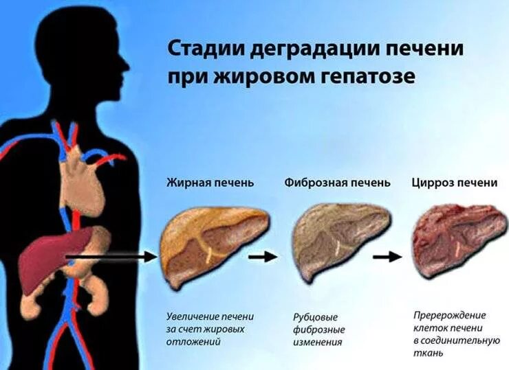 Убрать жировую печень. Восстановление печени.