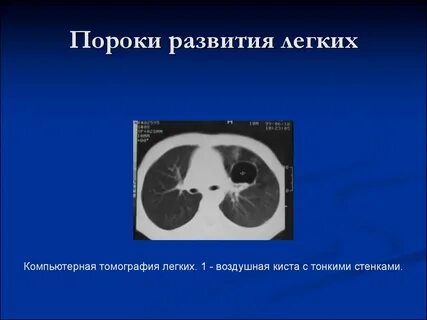 Порок легких