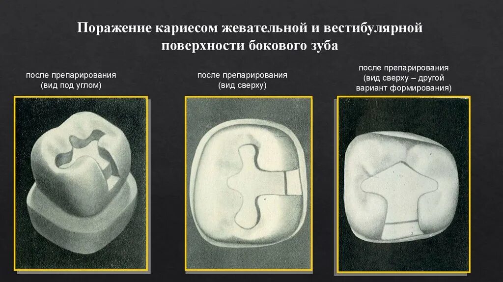 Препарирование это. Профилактическое расширение кариозной полости. препарирование окклюзионной поверхности. превентивное расширение кариозной полости. кариес окклюзионной поверхности зубов.
