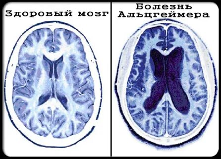 Мозг при окр