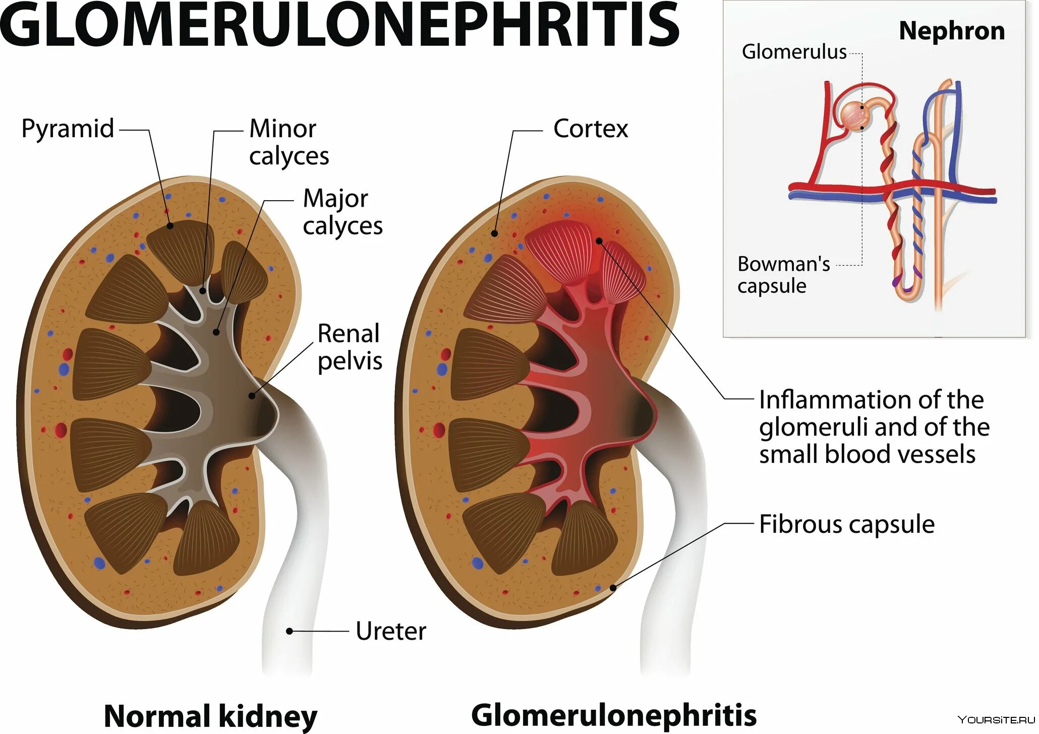 Описание строения почек. Глобулярный аппарат почки. Острый пиелонефрит по узи. Нормальная почка. Пиелонефрит патанатомия макропрепараты.