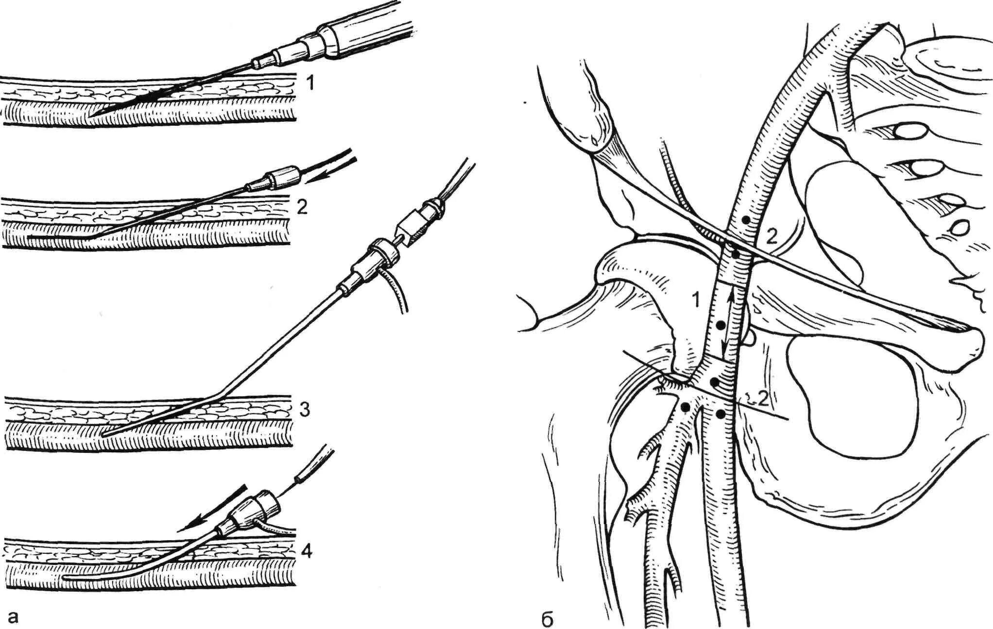 Операция через сосуды. Пункция бедренной артерии по Сельдингеру. Катетеризация артерий по Сельдингеру. Катетеризация бедренной вены по Сельдингеру техника пункция. Пункция бедренной вены.