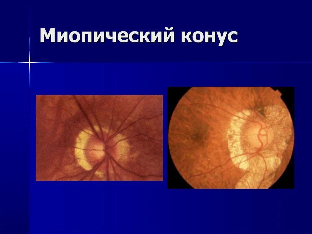 Миопический конус глазное дно. Миопические изменения на глазном дне. Темпорально миопический конус.
