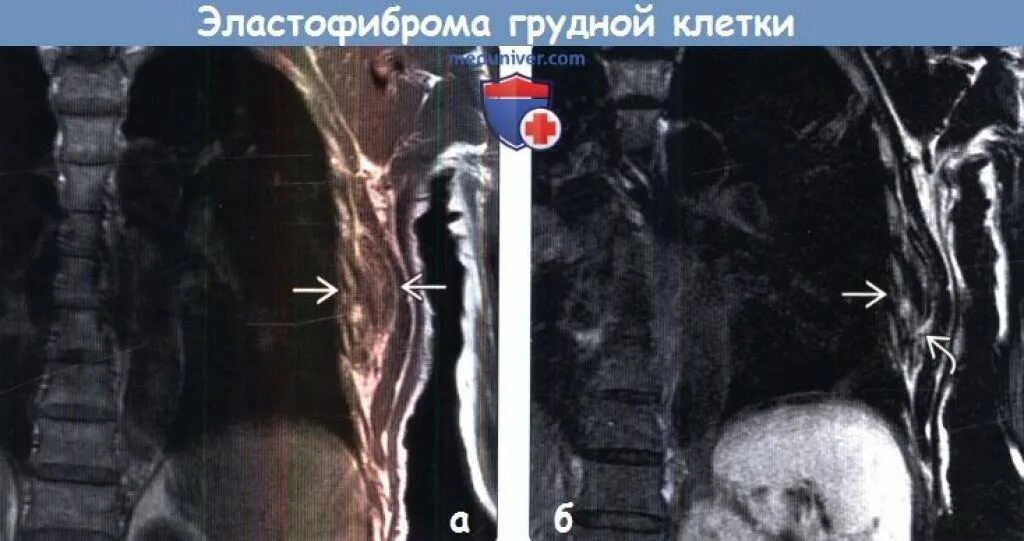 Эластофиброма подлопаточной области на кт.