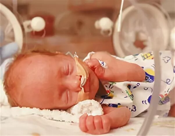 Ишемия у новорожденных последствия. Синдрома дыхательных расстройств у недоношенных детей.