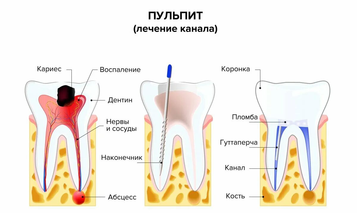 Причины почему болит зуб. 4 Канальный пульпит зуба. Пульпит 2 канального зуба.