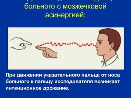 Интенционное дрожание