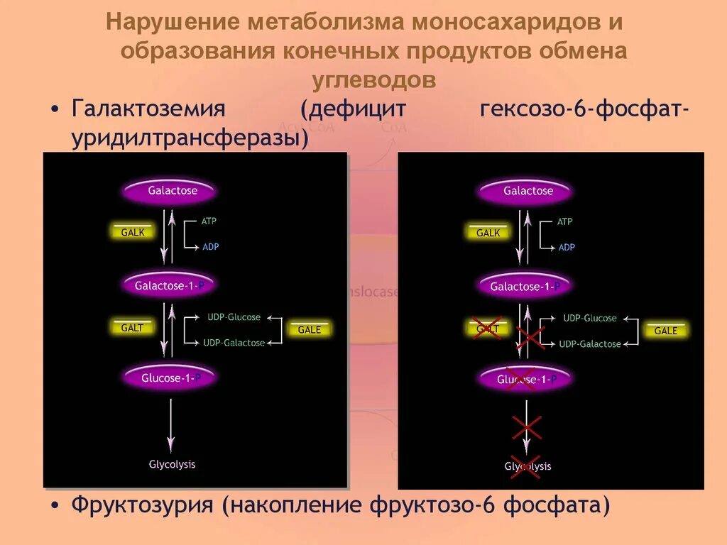 Заболевания обмена углеводов. Наследственные нарушения обмена галактозы. Наследственные нарушения обмена моносахаридов и дисахаридов.. Наследственные нарушения обмена моносахаридов. Нарушение обмена галактозы.