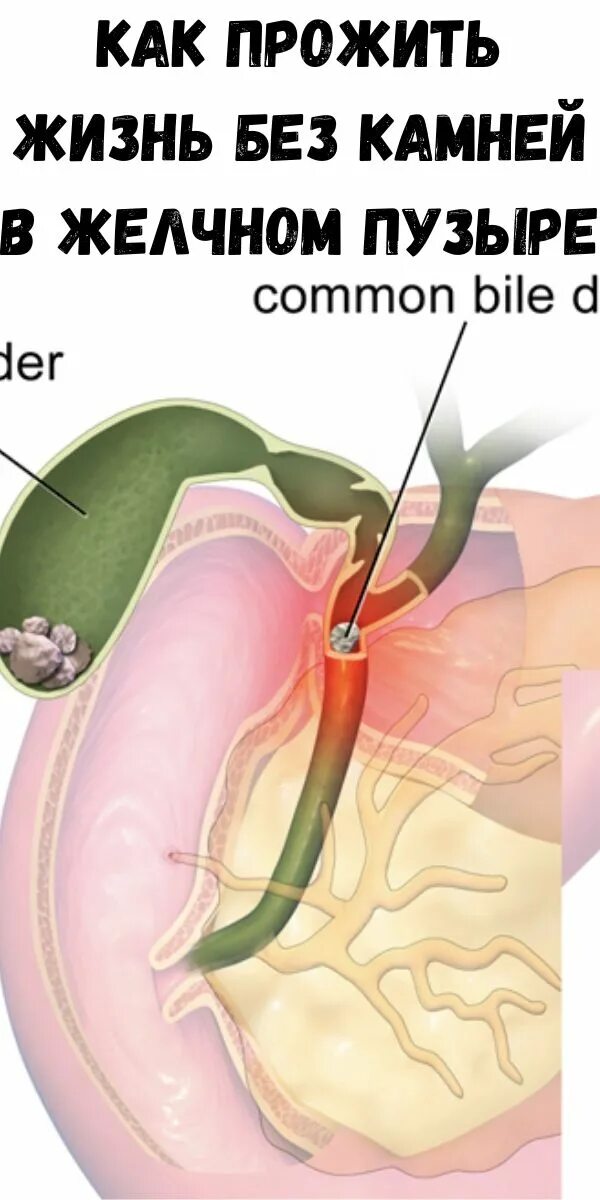Как жить без желчного отзывы. Камен в желичем пузеие. Отключенный желчный пузырь. Удаленные камни из желчного.