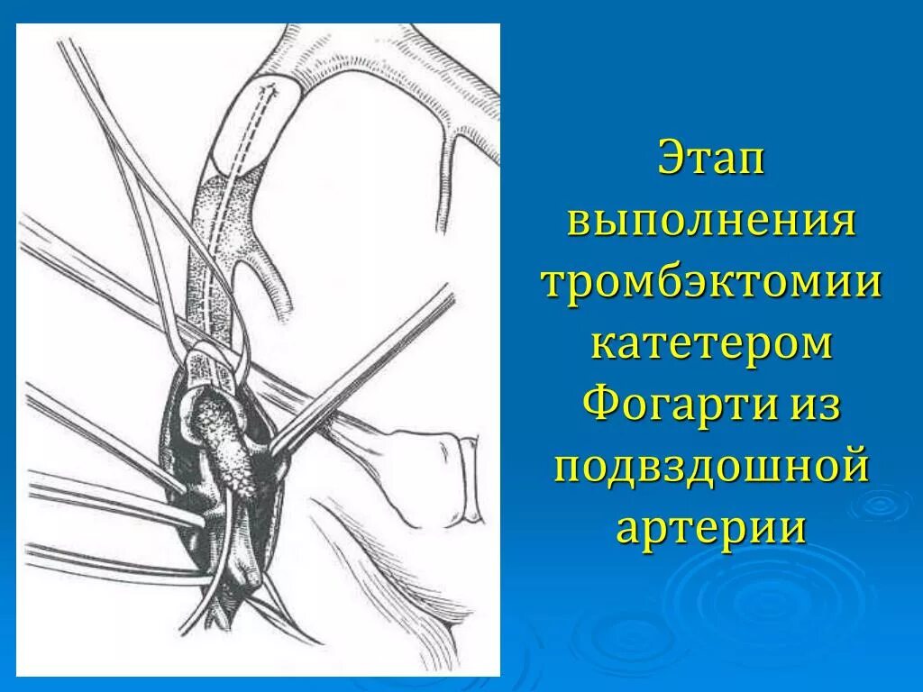 Катетер фогарти. Катетерная тромбэктомия. Тромбэктомия катетером Фогарти. Катетерная аспирационная тромбэктомия.