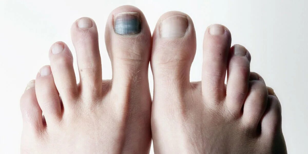 Ногти на больших пальцев мужчин. Гематома подногтевая гематома. Почернение пальца на ноге.