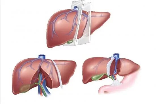 Трансплантация печени. Трансплантация печени операция. Ортотопическая трансплантация печени. Можно ли пересадить печень
