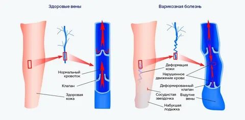 Воздух в венах