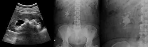 УЗИ почек - патология (лекция на Диагностере) - Диагностер