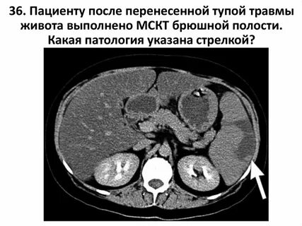 Селезенка полость