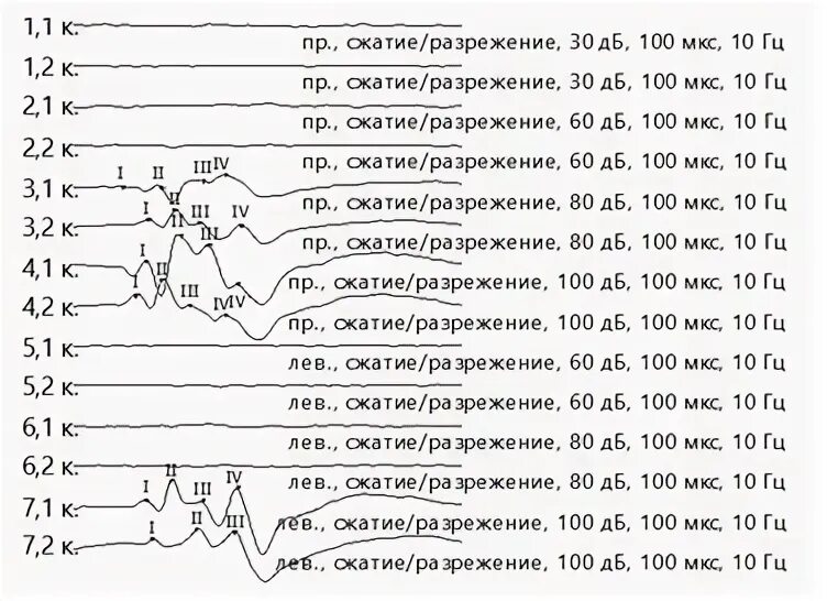 30 мкс частота. Акустические вызванные потенциалы. Акустические стволовые вызванные потенциалы с показателем 6,5.