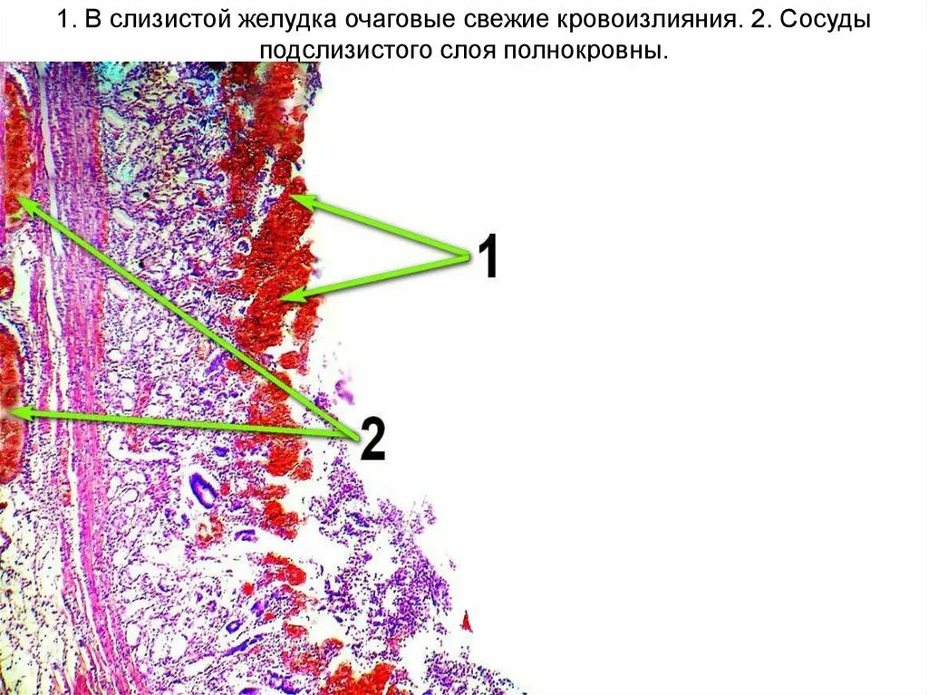 Инфаркт стенки кишки препарат. Инфаркт кишечника гистология. Инфаркт кишечника микропрепарат. Инфаркт стенки кишки микропрепарат. Слизистые оболочки почек