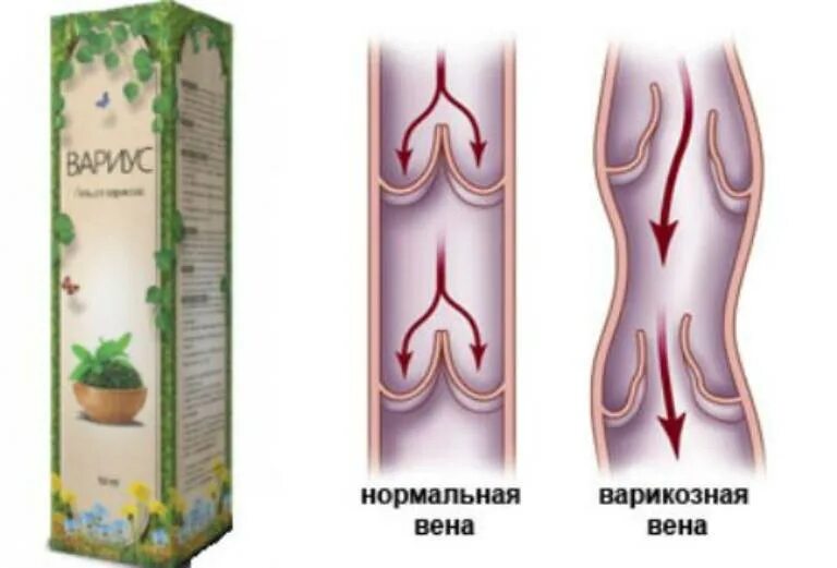 Вены на ногах мазь отзывы. Нормальная и варикозная Вена. Гель от варикоза. Вариус мазь.