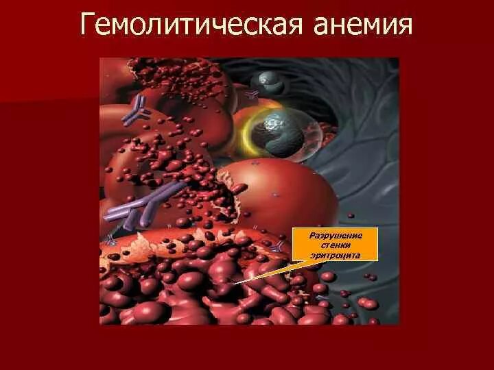 Приобретенные гемолитические анемии. Лекарственная гемолитическая анемия. Хроническая гемолитическая анемия. Аутоиммунная гемолитическая анемия.