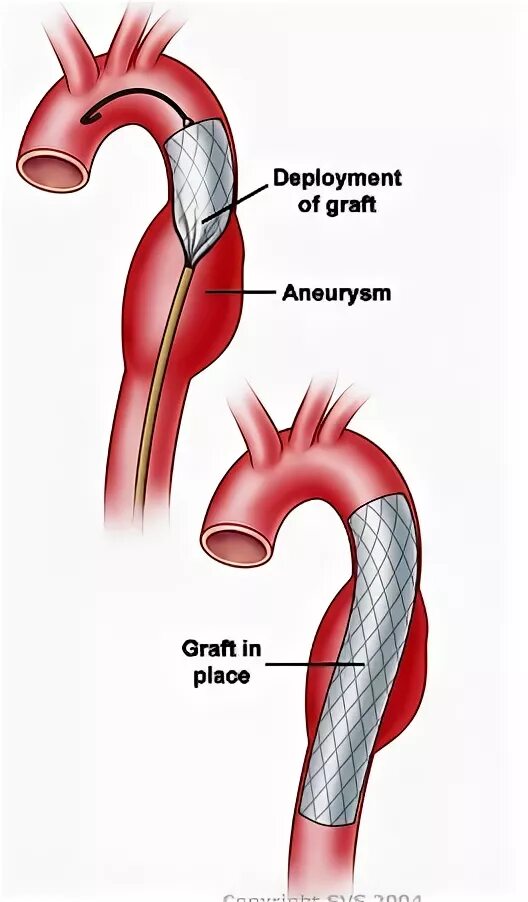 Стентирование аневризмы. Стентирование аневризмы аорты. Стент графт грудной аорты. Аневризма брюшной аорты стент графтом.